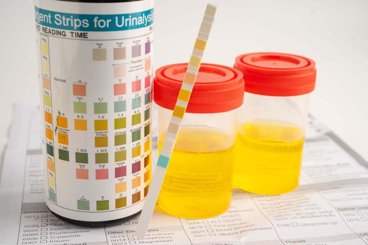 Urinalysis results and reference values – symptoms, color, deviations