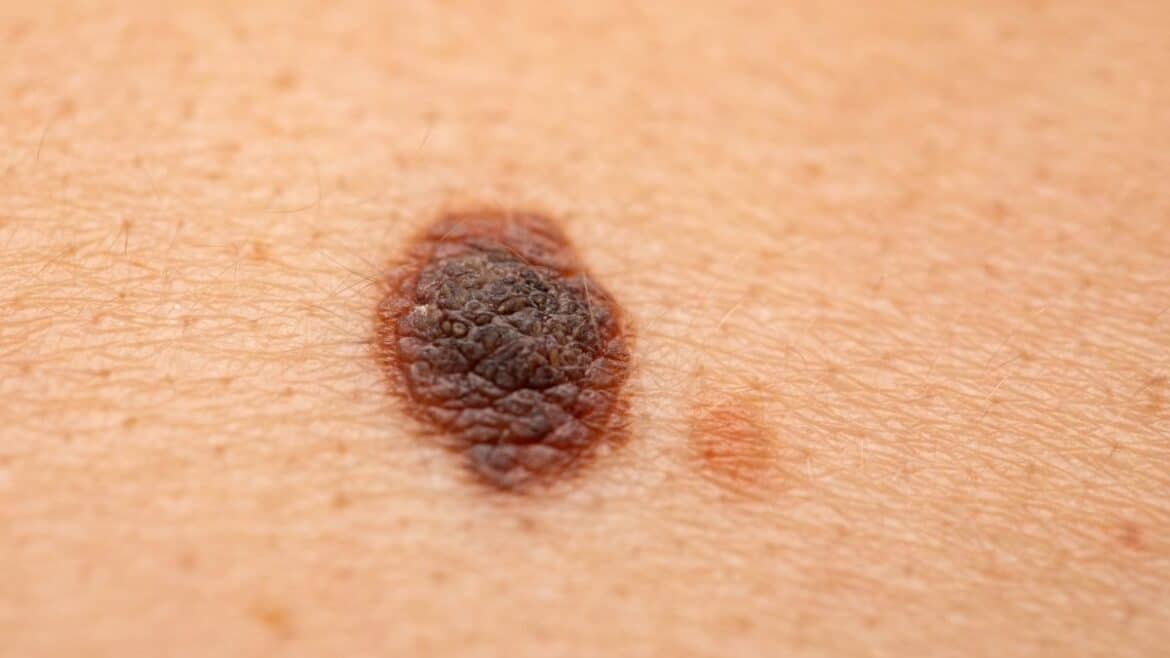 melanoma of the skin