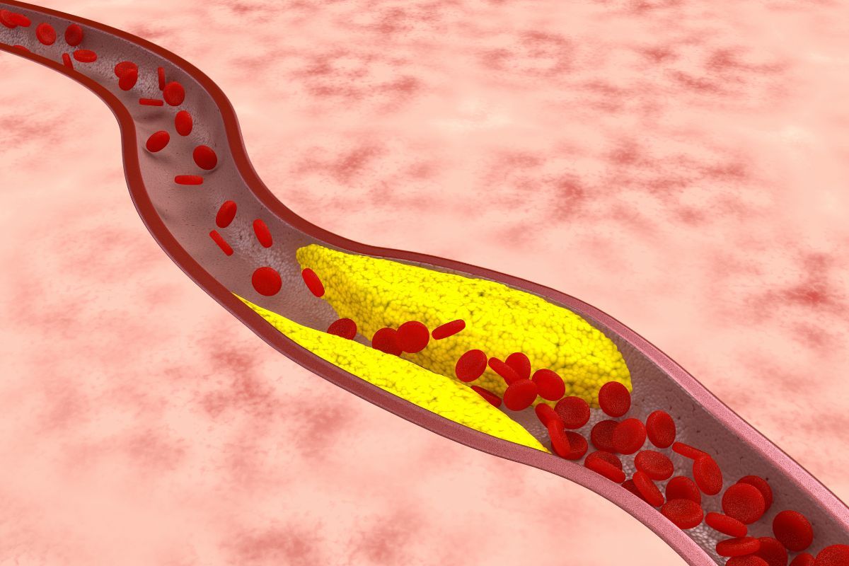 Symptoms of atherosclerosis, effective prevention, and atherosclerosis treatment