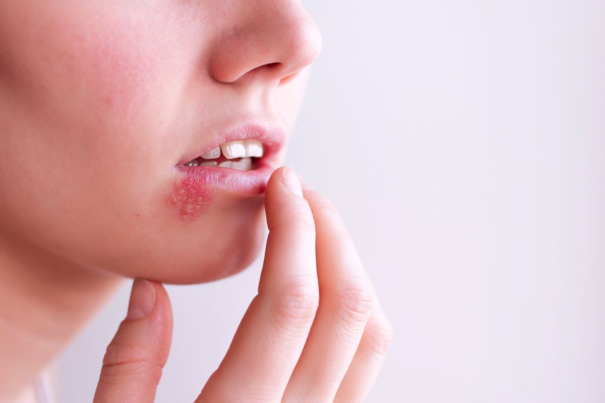 Herpes on the lips – effective prevention, causes and step-by-step treatment