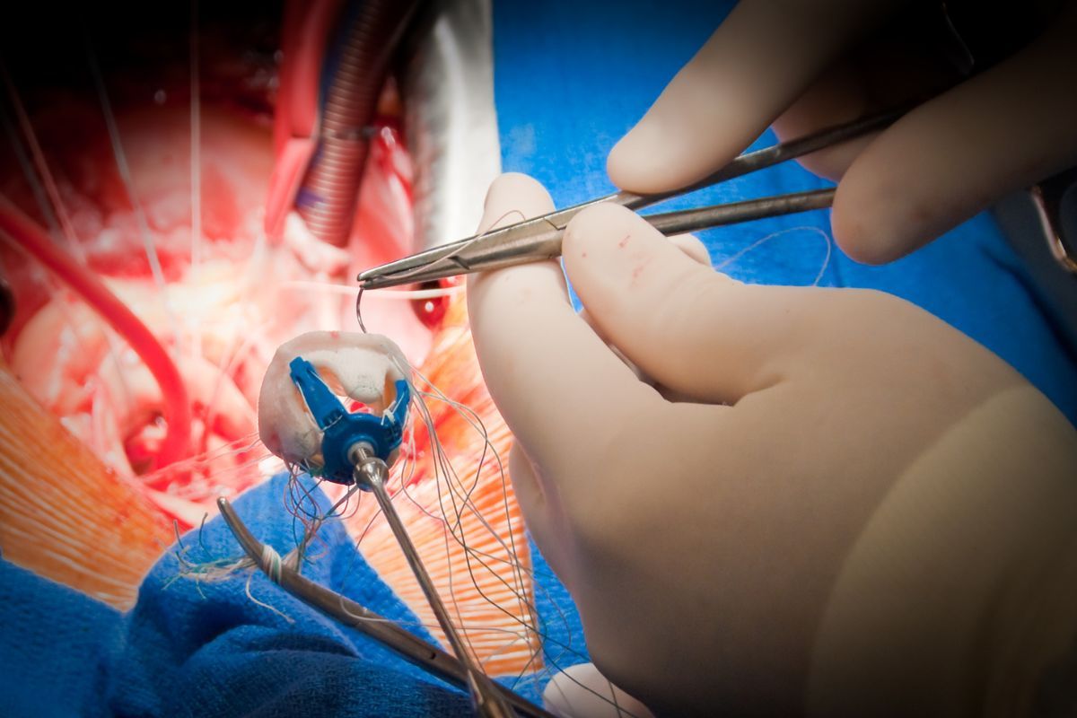 Aortic aneurysm symptoms diagnosis treatment prevention and risk