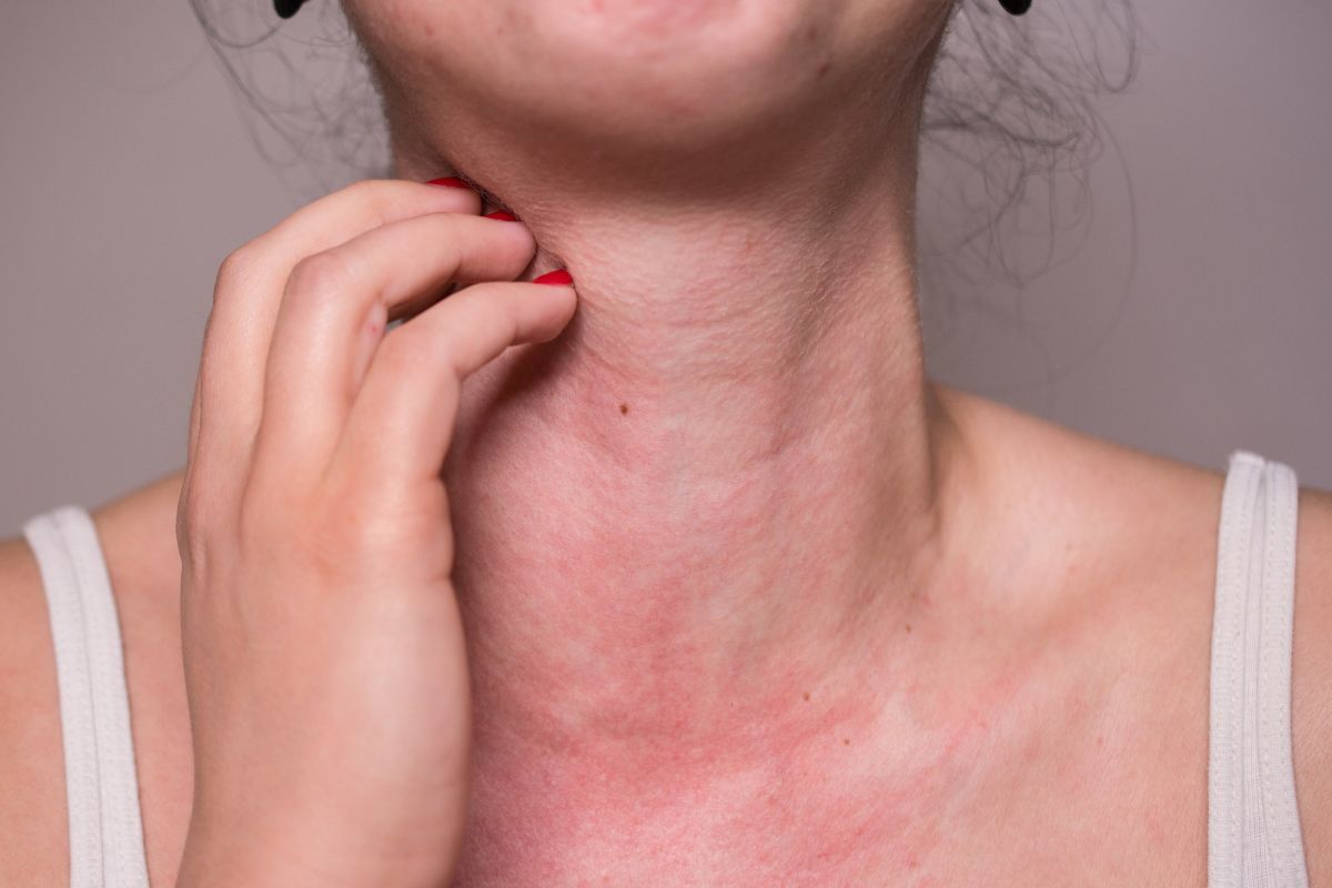 Photodermatosis sun allergy symptoms treatment and skin prevention