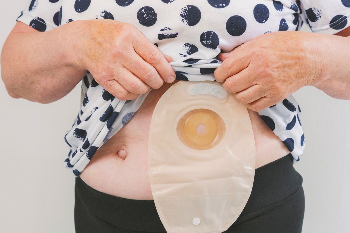 Życie ze stomią jak zaakceptować i odzyskać komfort oraz radość na co dzień